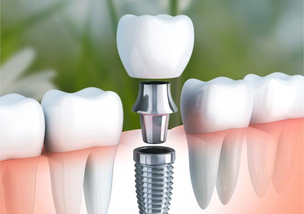 Dental Implants