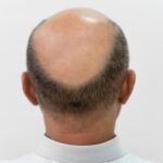 Hair Transplant Technology in Istanbul