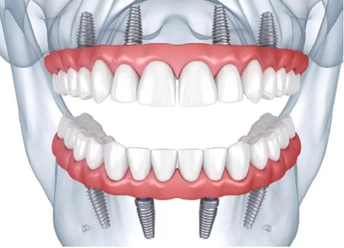 Full Mouth Dental Implants Cost Cheapest Full Mouth Dental Implants Cost Cheapest