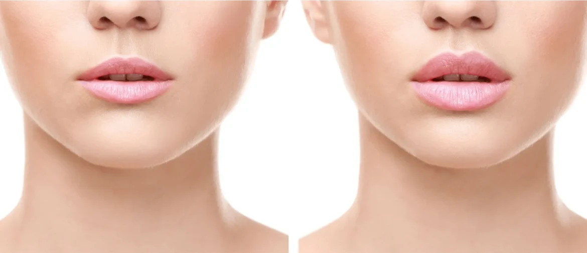 Dermal Fillers For Lips