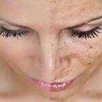 10 Important Things to Know before You Go for Laser Scar Removal