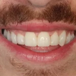 The Exact Process Behind Your Composite Bonding Middlesbrough Treatment