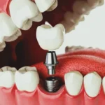 What is recovery time after Dental Implants Newcastle surgery completion